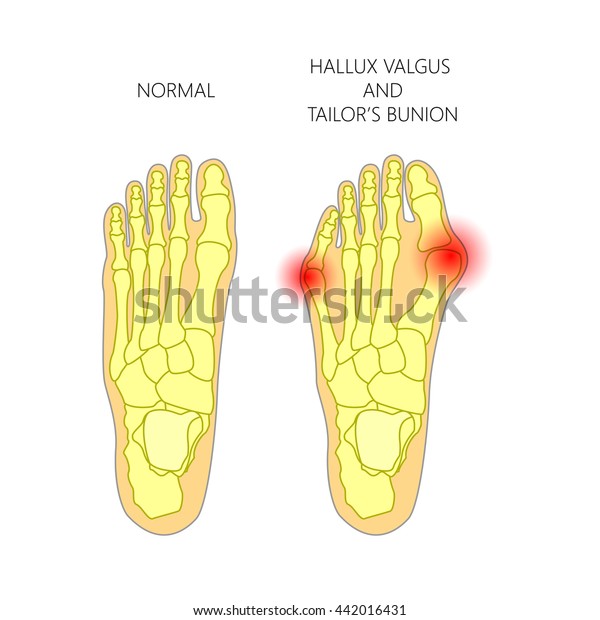 Illustration Normal Foot Valgus Deviation First Stock Vector (Royalty ...