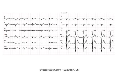 Illustration Of Normal Human Electrocardiogram Or EKG 12 Leads On White Background. Vector Illustration.