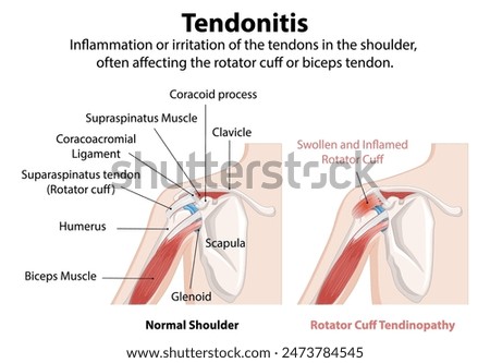 Illustration of normal and inflamed shoulder tendons