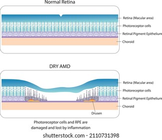 Illustration Of Normal Retina And Dry AMD (Age Related Macular Degeneration) . 