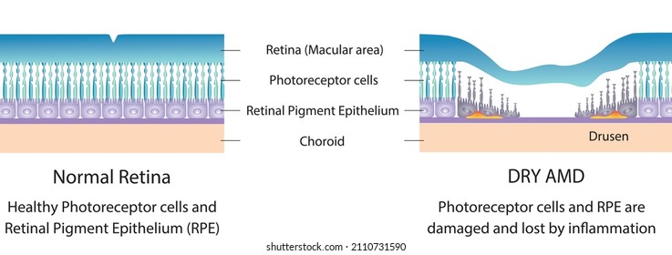 Illustration Of Normal Retina And Dry AMD (Age Related Macular Degeneration) . 