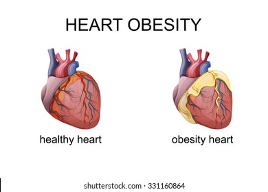 Illustration Of Obesity Heart. Comparison