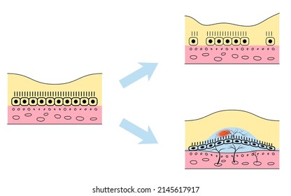 Illustration of Ocular Disease, Atrophic Age-Related Macular Degeneration and Exudative Age-Related Macular Degeneration