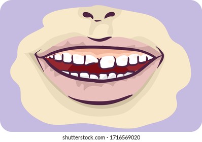 Illustration of an Open Mouth with Chipped Tooth Symptom of Decay