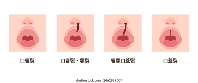 Illustration of opening the mouth_translation: cleft lip, cleft lip,cleft jaw, cleft lip, jaw palate, cleft palate