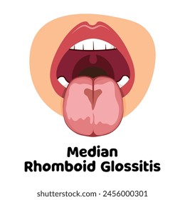 illustration of the oral infection disease glossitis, great for media infographics, banners and flyers