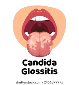 illustration of the oral infection disease glossitis, great for media infographics, banners and flyers