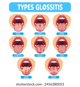 illustration of the oral infection disease glossitis, great for media infographics, banners and flyers