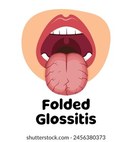 illustration of the oral infection disease glossitis, great for media infographics, banners and flyers