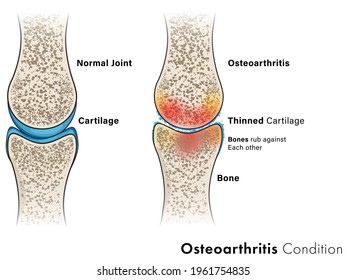 Illustration Of Osteoarthritis Disease Of Bone. Cartilage Disease.