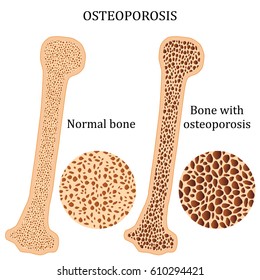 Illustration of osteoporosis bone and healthy bone.