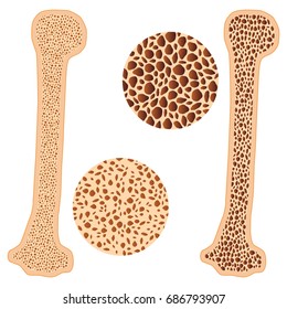 Illustration of osteoporosis bone and healthy bone on the white background.