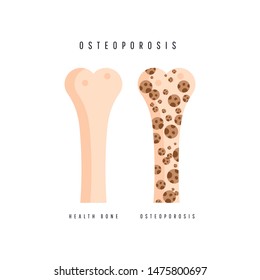 Illustration of osteoporosis bone and healthy bone. Two bones are normal and sore.