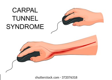 illustration of pain in carpal tunnel syndrome