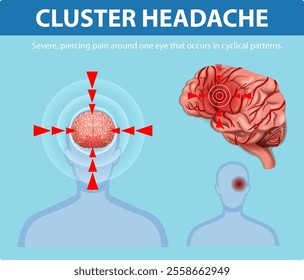 Illustration of pain patterns in cluster headaches