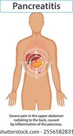 Illustration of pancreatitis affecting the human body