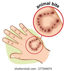 Illustration Is Part Of The Human Body, Hand With An Animal Bite. Ideal For First Aid, Medical And Institutional Materials