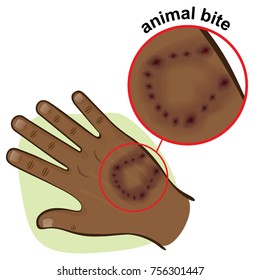 Illustration is part of the human body, hand with an animal bite, African descent. Ideal for first aid, medical and institutional materials