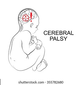 illustration of patient with cerebral palsy. Child.