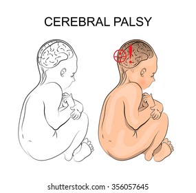 Illustration Of Patient With Cerebral Palsy. Child.