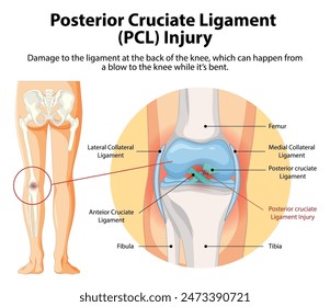 Illustration of PCL injury in the knee