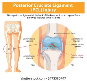 Ilustración de la lesión PCL y la anatomía de la rodilla