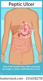 Illustration of peptic ulcer affecting the stomach area