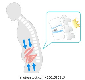 Illustration of a person with a compression fracture that causes bad posture and compression of internal organs.