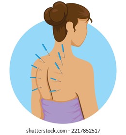 Illustration person receiving acupuncture, alternative treatment, Chinese medicine. Ideal for catalogues, newsletters and medical guides