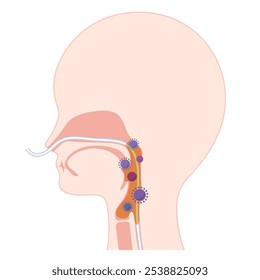 Illustration of the pharynx with increased phlegm and bacteria due to nasogastric tube feeding