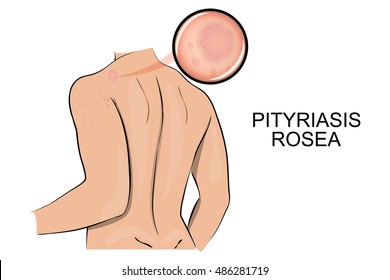 illustration of  pityriasis rosea. dermatology. increase under the microscope.