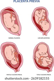 illustration of placenta previa types - vector