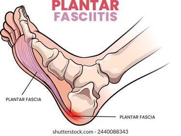 illustration of plantar fasciitis diagram - vector