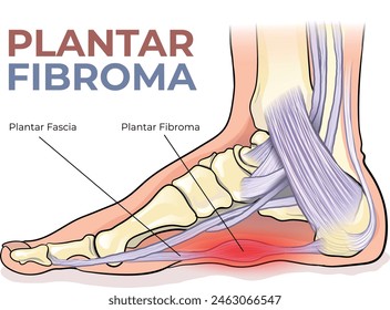 illustration of plantar fibroma diagram - vector