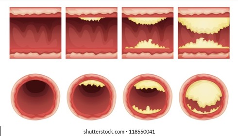 Illustration of plaque accumulation in a vessel