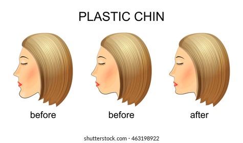 illustration of plastic surgery of the chin. mastoplastica before and after.
