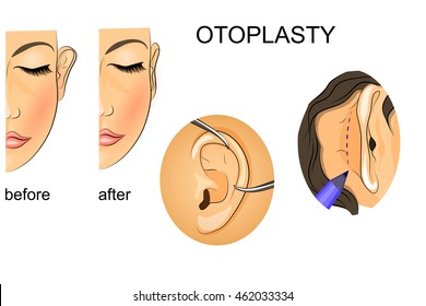 illustration of plastic surgery. correction of protruding ears
