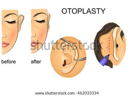 illustration of plastic surgery. correction of protruding ears