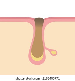 Illustration of pores clogged with keratin plugs