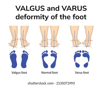 Illustration of the position of the feet in varus and valgus deformities. Depicted is a rear view of the feet and an imprint of the feet 