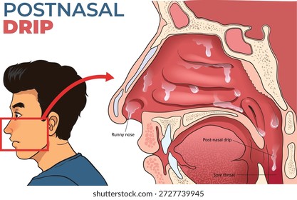 ilustração do diagrama de gotejamento pós-nasal 