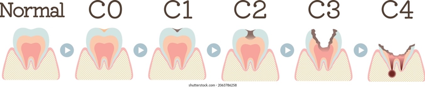 Illustration of the process of becoming cavities(Co-C4)