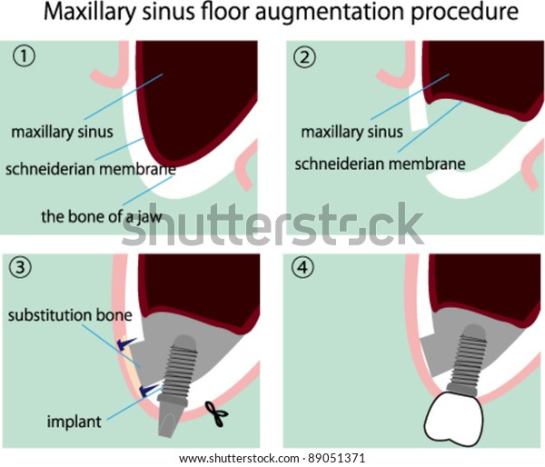 Illustration Process Maxillary Sinus Floor Augmentation Stock