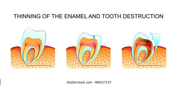 an illustration of the process of thinning of enamel and tooth decay

