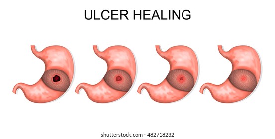 an illustration of the process of ulcer healing