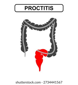 Illustration of proctitis ulcerative colitis. Inflammation of the human digestive system. Inflammatory bowel disease, Inflammation of the human digestive system. Vector drawing illustration for medical