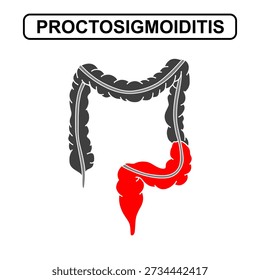 Illustration of proctosigmoiditis ulcerative colitis. Inflammation of the human digestive system. Inflammatory bowel disease, Inflammation of the human digestive system. Vector drawing illustration for medical