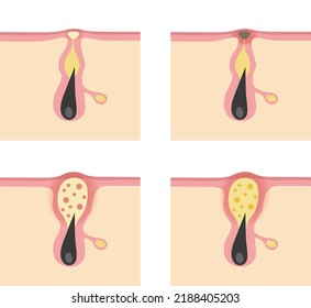 Illustration of the progression of acne