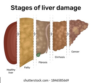 Illustration of the progression of liver disease from fatty liver to cancer