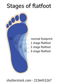 Ilustración de la etapa de progresión de los pies planos.
Se superponen diferentes etapas de los pies planos a la imagen de la huella de un pie sano. 